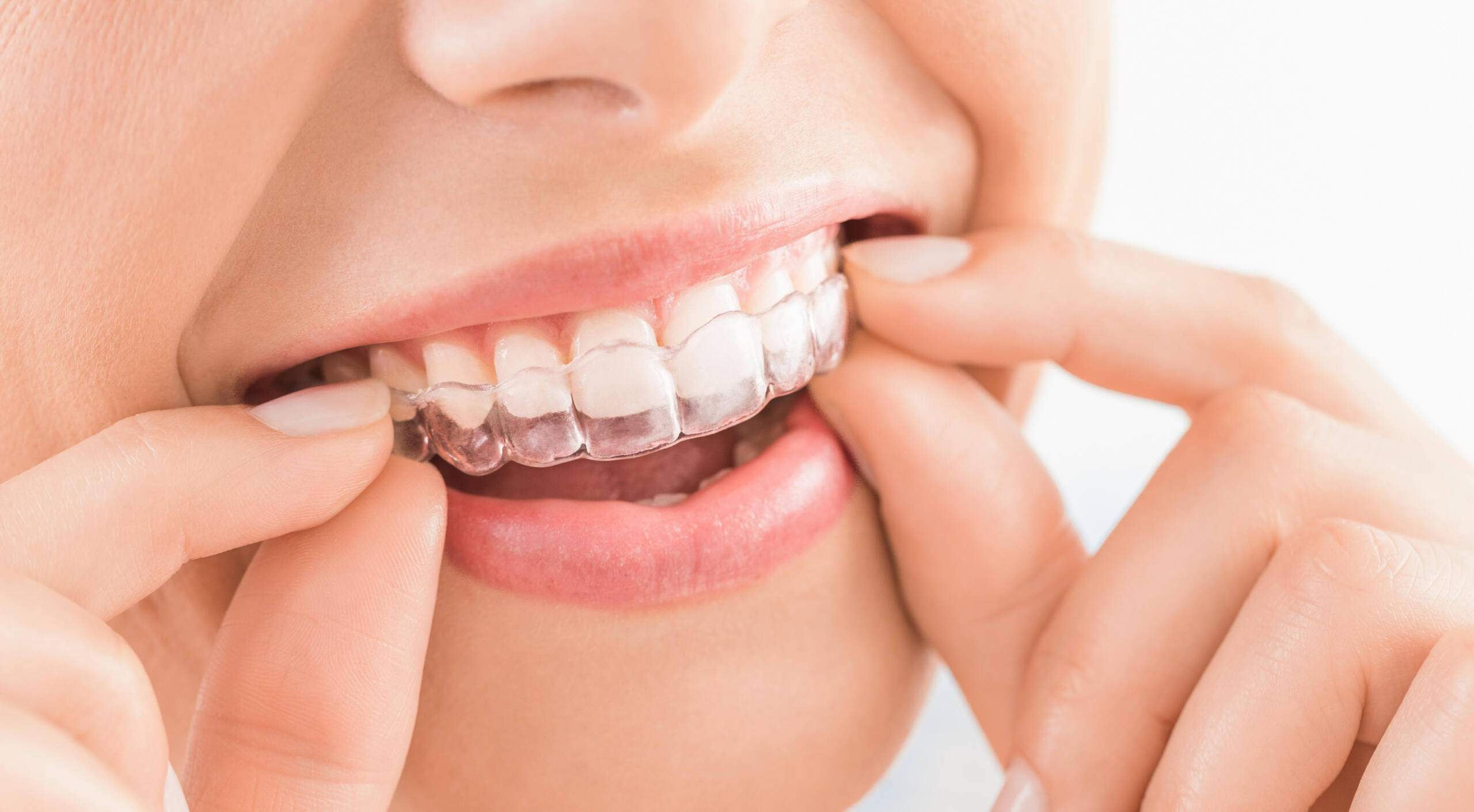 Invisalign for Teens