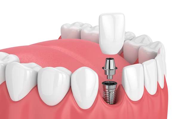 pain-free dental implants