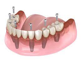Full-Mouth Dental Implants