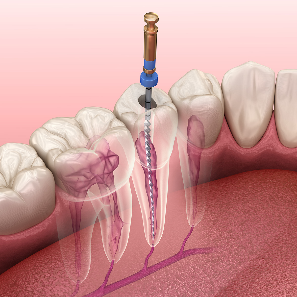 Root canal treatment